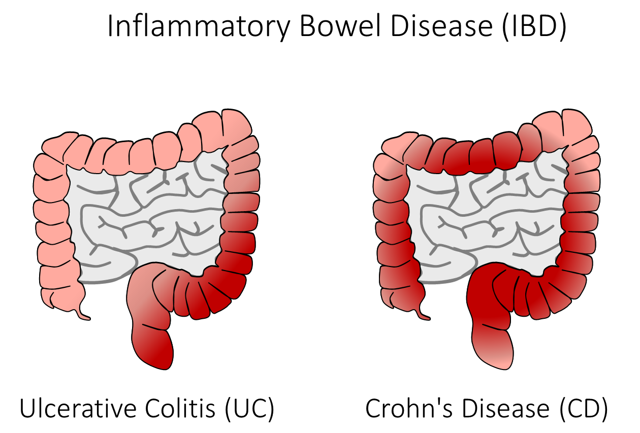 Crohns vs. Colitis