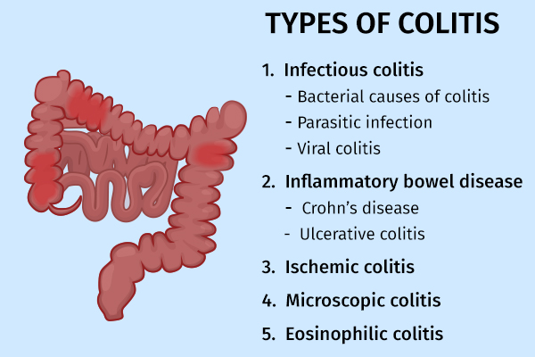 types of colitis